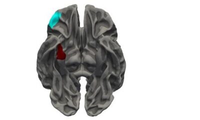 bRAIN 1