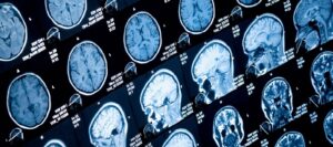 Breakthrough in Brain Cancer Research Made by Newcastle Experts