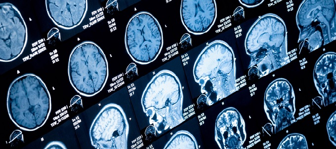 Breakthrough in Brain Cancer Research Made by Newcastle Experts 61 newcastle 1