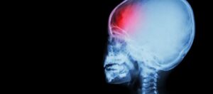 Childhood Head Injuries Linked To Increased Risk Of Adult Mental Illness And Poorer Life Chances