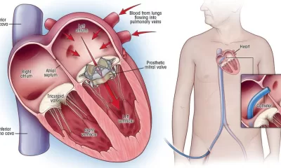 When heart valves fail 1