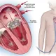 When heart valves fail 1