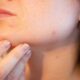 Best Ways to Get Rid of Acne