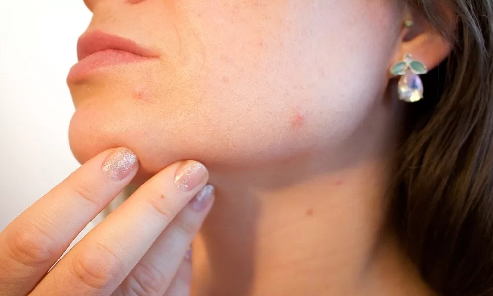 Best Ways to Get Rid of Acne