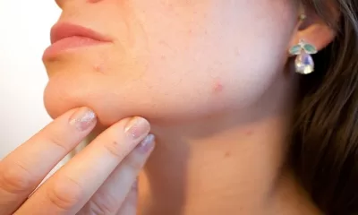 Acne Treatment: Types, Side Effects, and More