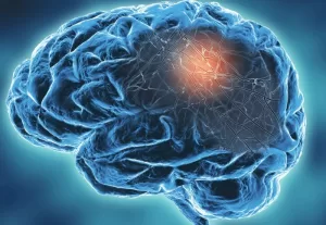 Lasting Brain Impacts of Severe COVID-19 Equivalent to 20 Years of Ageing