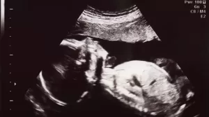 Researchers Evaluate Attempts to Improve Detection of Small Babies During Pregnancy