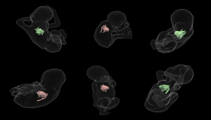 New Fetal Shape Analysis Can Predict Need for Baby’s Life-Saving Surgery