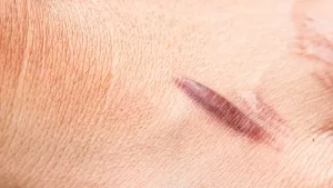 Excessive Scarring Shown to Be Associated with Atopic Eczema, Hypertension and Musculoskeletal Diseases