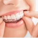 Clear Aligners