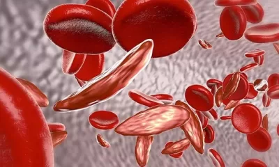 Sickle Cell Disease