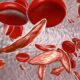 Sickle Cell Disease