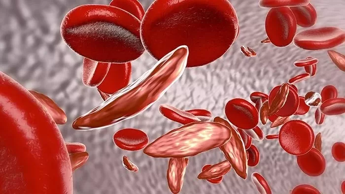 Sickle Cell Disease