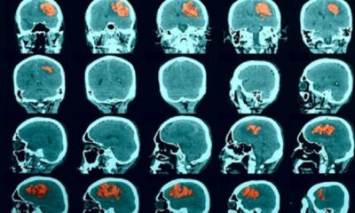 Breakthrough Study Unveils Promising Treatment for Deadly Brain Bleed