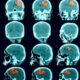 Breakthrough Study Unveils Promising Treatment for Deadly Brain Bleed