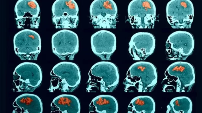 Breakthrough Study Unveils Promising Treatment for Deadly Brain Bleed 61 depression