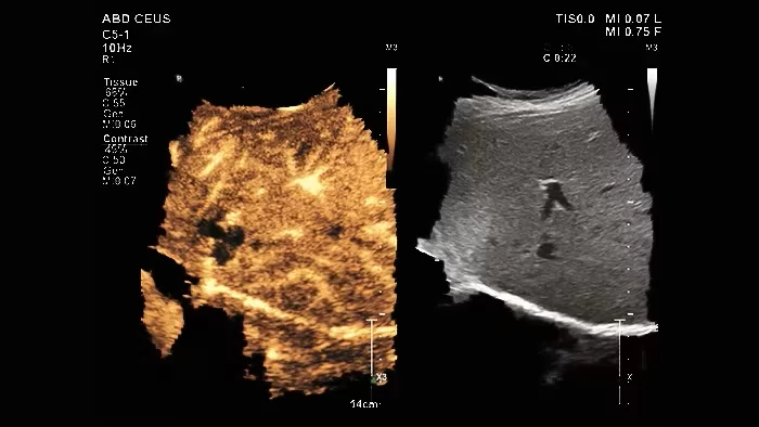 Advancing Cancer Diagnostics with Philips' Super Resolution Contrast-Enhanced Ultrasound